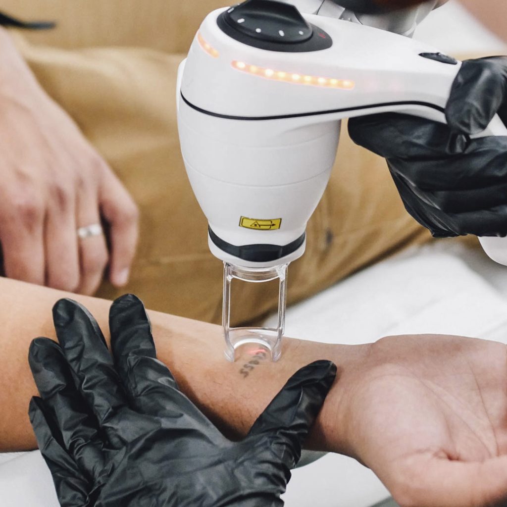 Laser for tattoo removal